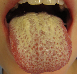 Pathogenesis and treatment of oral candidosis