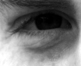 treating dark eye circles treating dark eye circles
