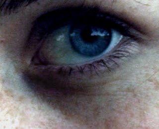 Dark circles under the eyes Dark circles under the eyes